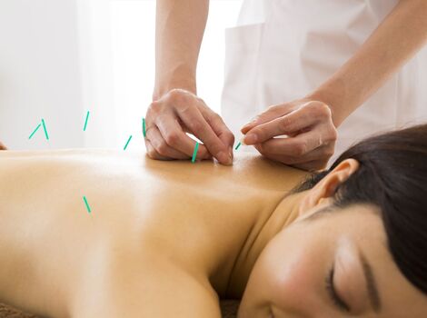 背中前面に鍼を打たれた女性_R